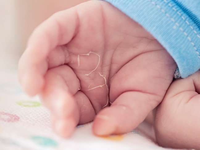 Newborn Skin Peeling