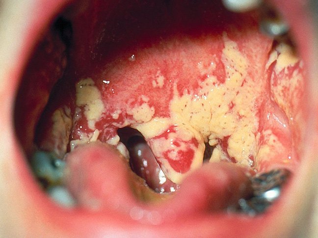 Oral Thrush