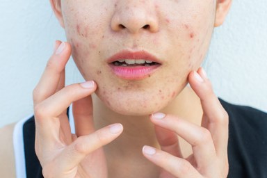 postpartum acne